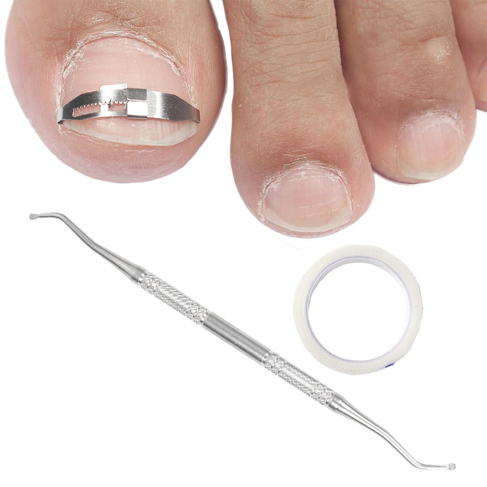 1Set Ingrown Toe Nail Correction Tool Toenail Straightening Correctors Patch Tool Kit Nail Repairer Orthosis Beauty Tools