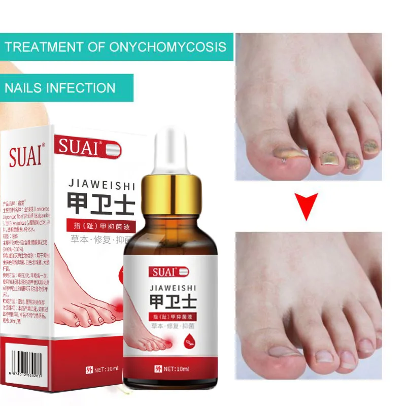 Nail Fungus Treatment Cream Onychomycosis Paronychia Anti Fungal Herbal