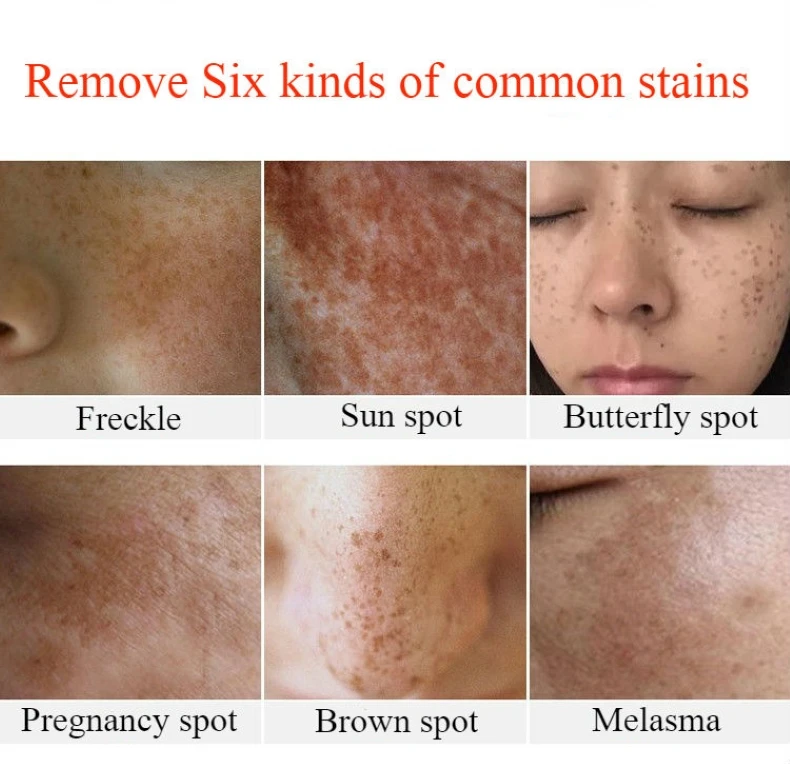 melasma spots