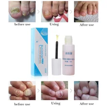 10 мл эфирные масла для ногтей Лечение ногтей от грибка бактерицидная эссенция Масло жидкое средство для ремонта ногтей инструменты для ухода за ногтями эссенция