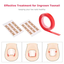 30 шт. наклейки для коррекции вросших ногтей выпрямление лечение восстановление корректор пальцев ног инструмент для ухода за ногтями