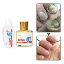 Противогрибковые средства для ногтей эссенция для лечения травяного восстановления пальцев для ухода за ногтями Здоровье и красота онихомикоз пароникция удаление инфекции