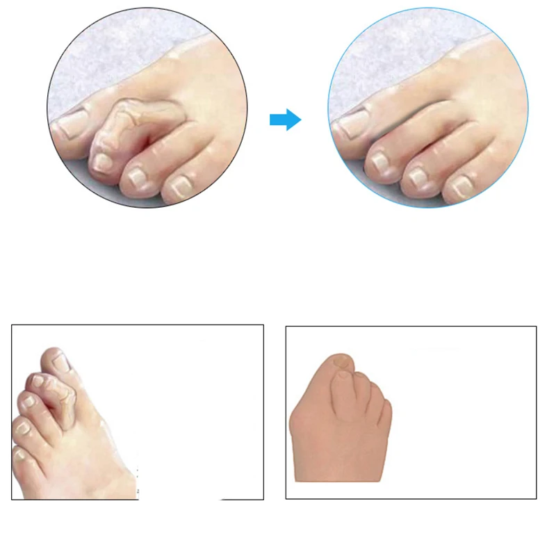 1Pair Gel Silicone Foot Corrector Tool Metatarsal Toe Gel Pad Forefoot Foot Pads Hallux Valgus Corrector 3