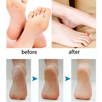 

4pcs Pedicure Durable Callus Remover Care Tool Electric Machine Coarse Hard Skin Replacement Parts Foot File Roller Head Grinder