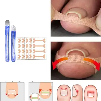 

Nail Groove Pedicure Set Groove Embedded Foot Device Roll Quick Pedicure Thumb Deformation Toe Patch Repair Nail Nail L1X9