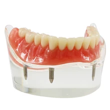 Implant dentystyczny Overdenture Model 4 lokalizatory dolna szczęka NISSIN Kilgore Style M6003 tanie tanio Dentalmall CN (pochodzenie) Z żywicy