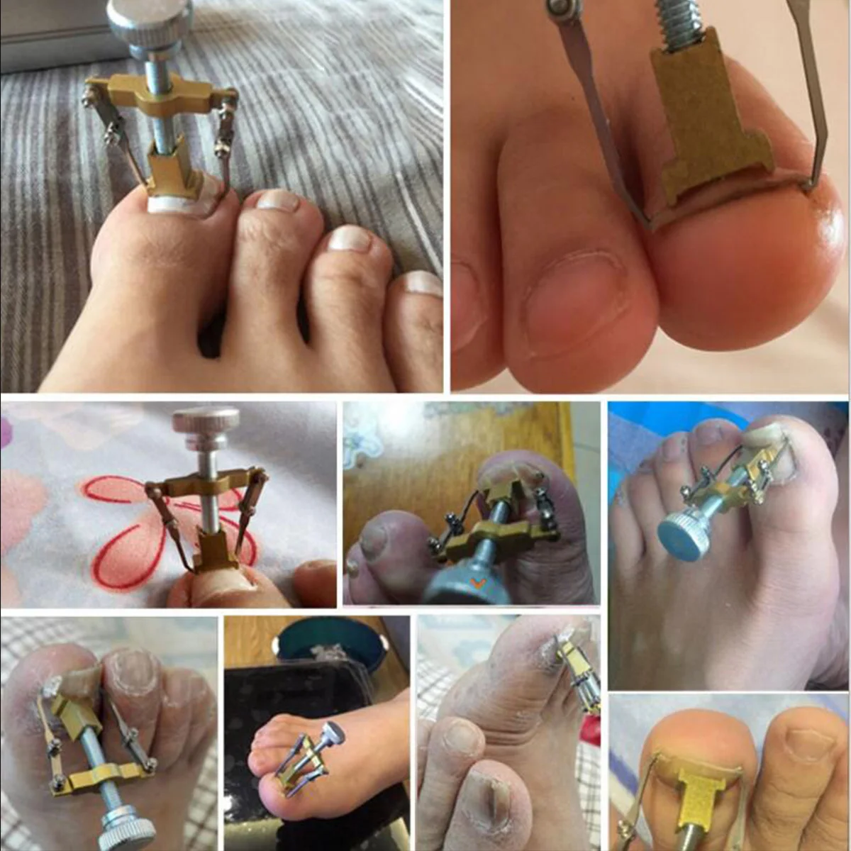 Ingrown Toe Nail Fixer Pedicure Toenail Recover Nail Correction Tool Orthotic Nail Bunion Corrector Foot Nail Care