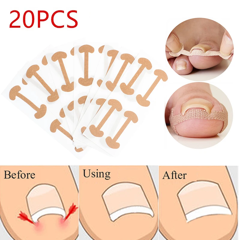 20pcs Professional Embedded Toe Nail Corrector Sticker Toenail Care Pedicure Thumb Curl Correction | Красота и здоровье