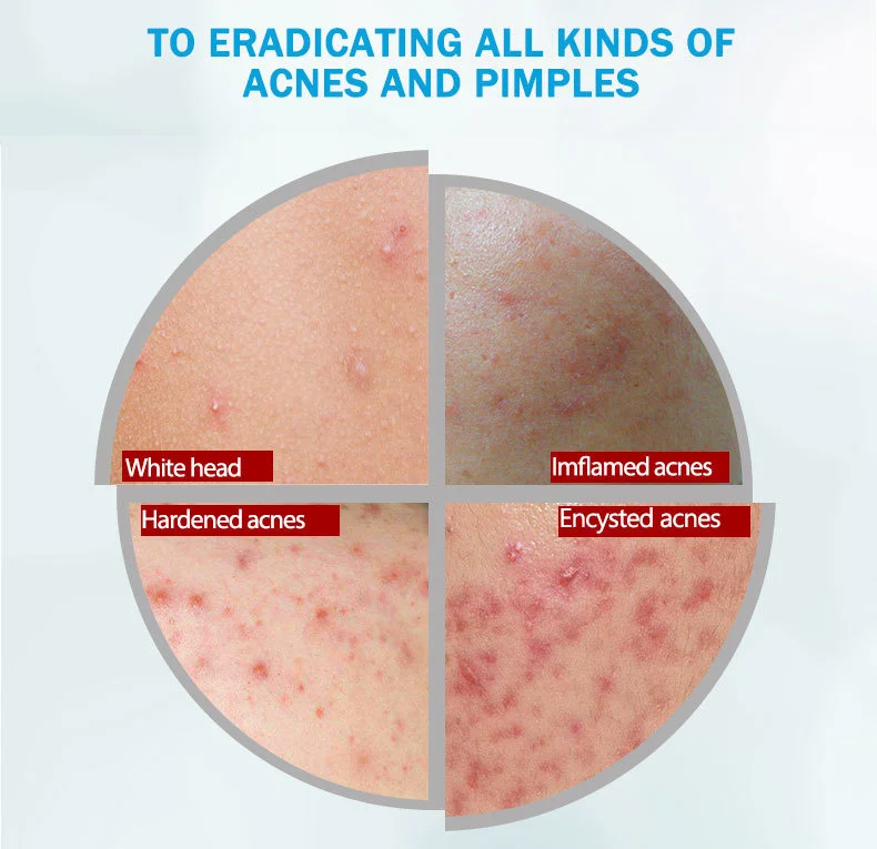 anti-acne_08