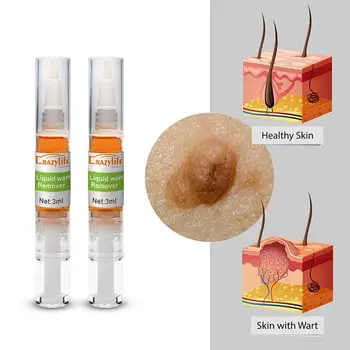 

2Pcs Crazylife foot cleft removal toe wart liquid wart pen skin tag Foot Corn Removal Warts callus thorn patches Corns of foot