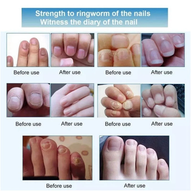 Новые эффективные носок Лечение грибка ногтей антибактериального ухода за ногтями для кожи вокруг глаз против грибковые лечения ручка