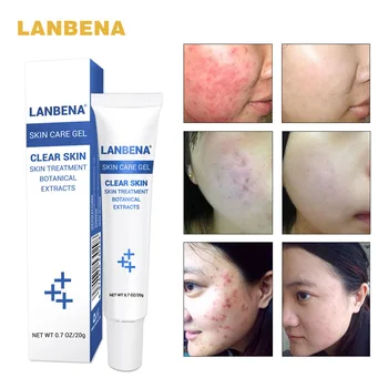 

acne treatment gel acne cleansing cream blackhead remover acne blemishes face acne scars skin care repair comedone pimple Lanben
