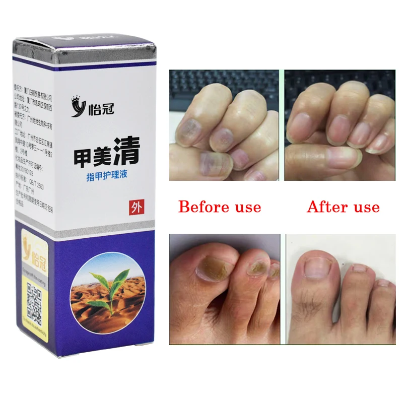 Fungal_Nail_Feet_Care_Essence_Nail_Foot_Whitening_Toe_Nail_Fungus_Removal_Gel_Anti_Infection_Paronyc (4)