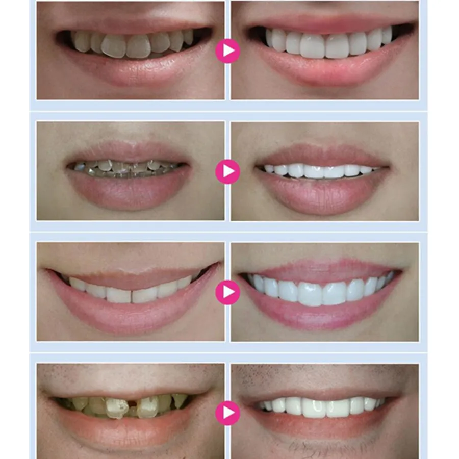 Dentist Dental Lab Equipment Teeth Tanden Whitening 44% Peroxide Bleaching System Oral Hygiene Care Gel Kit teeth whitening gel,teeth whitening kit