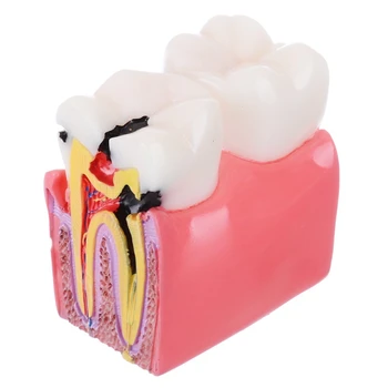 

1Pc Anatomy Education Teeth Model 6 Times Caries Comparative Study Models for Dentist Studying and Researching