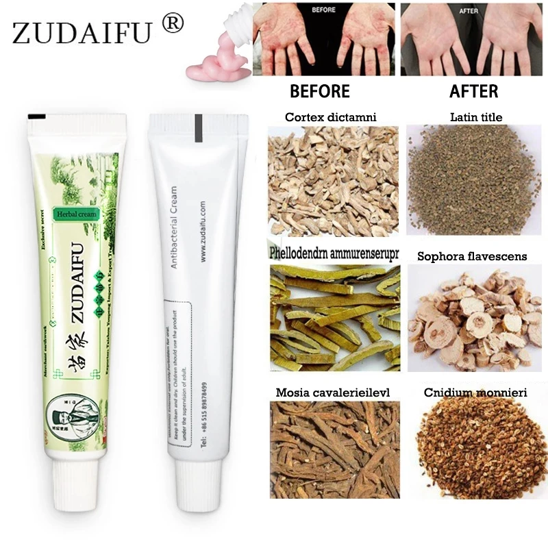 Dropshipping Zudaifu Skin Psoriasis Cream Dermatitis Eczematoid Eczema Ointment Treatment Psoriasis Cream Skin Care Cream