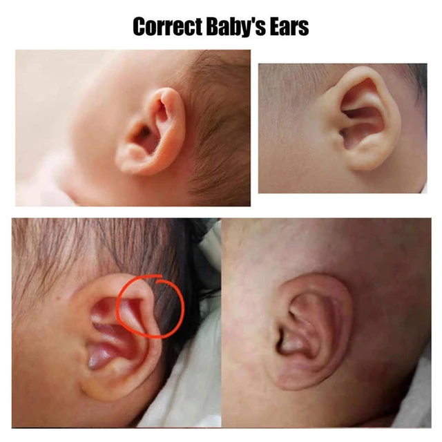 Otostick Baby - Best Protruding Ear Corrector for Babies