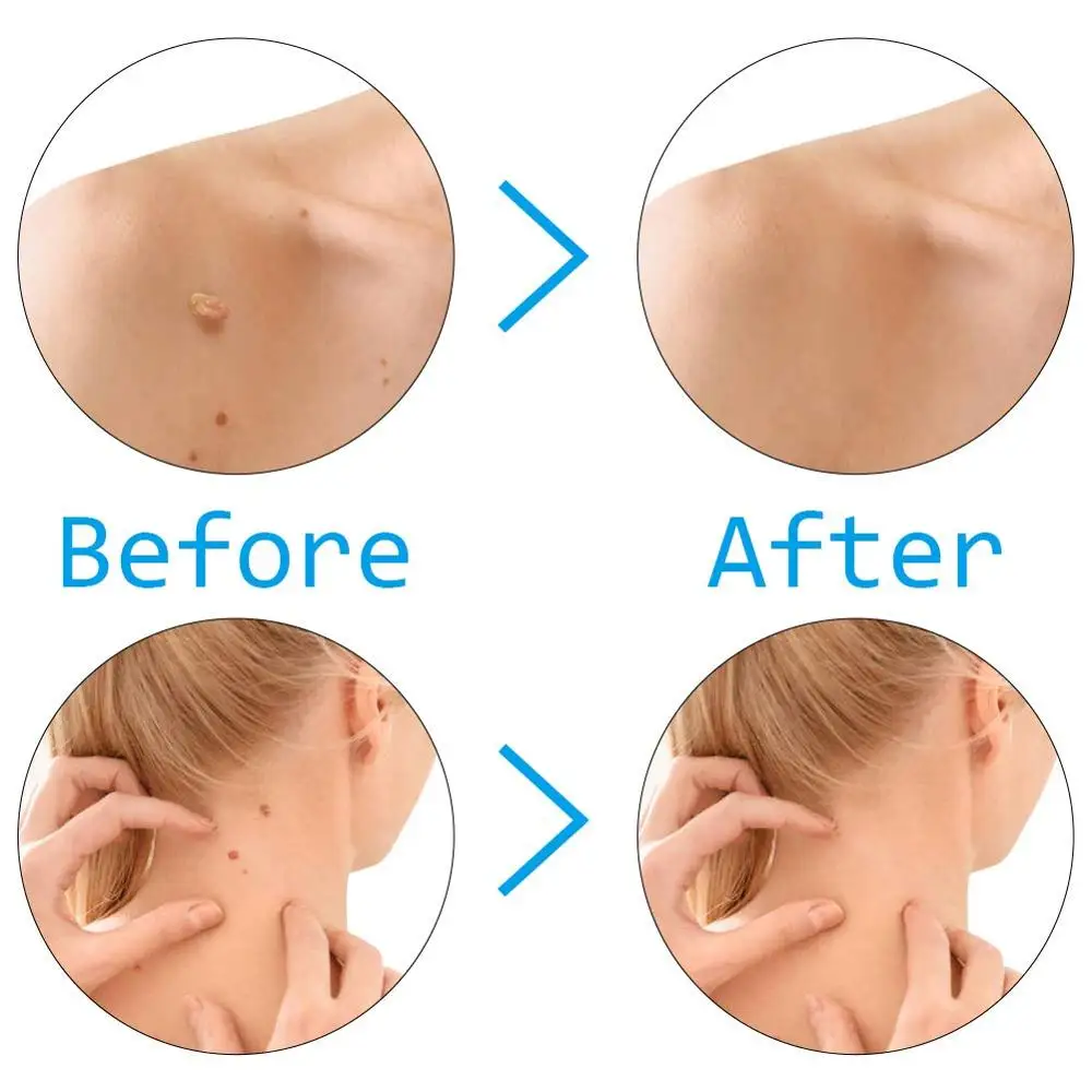 

skin tag remover remove Medical Skin Tag Kill mole wart treatment face Skin Tag Removal Tool Acne Remover Cleansing Micro Band