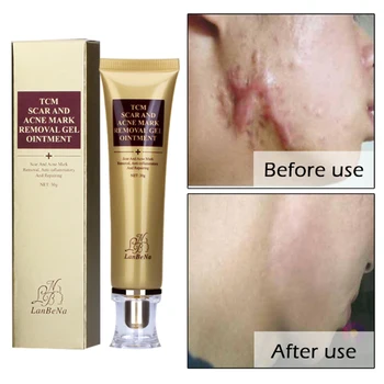 

Removal of Scars And Scars Instrument Acne Mask Removing Gel Ointment Lambena Skin Repair Labena Facial Treatment Scream Lanbena