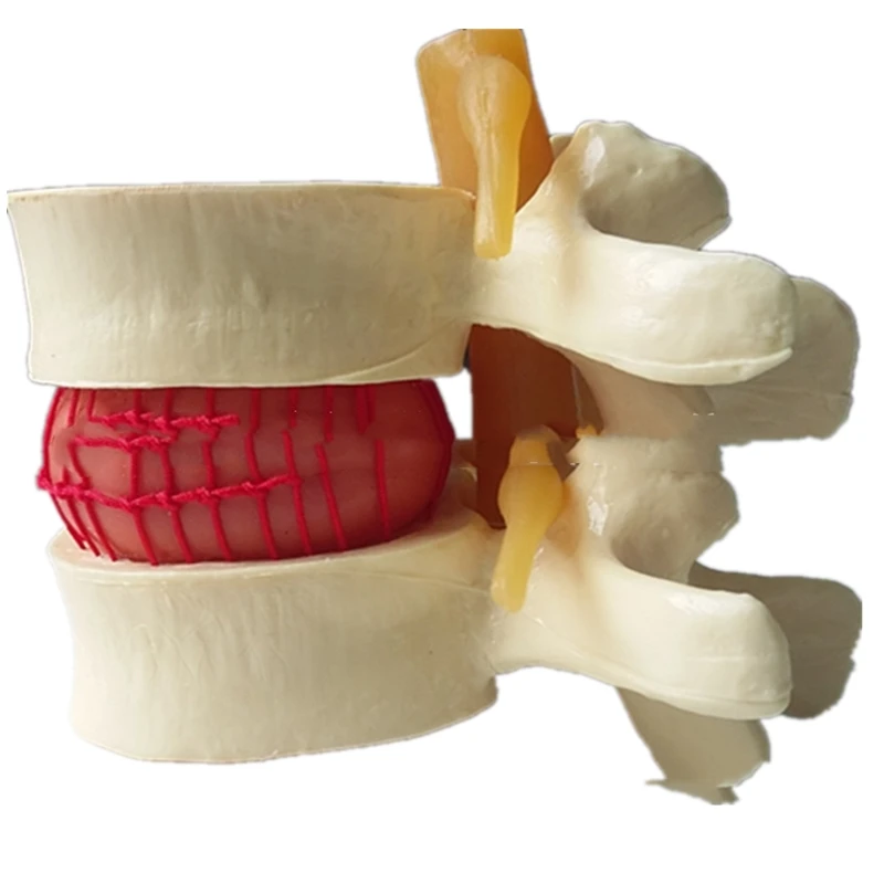 Lumbar Disc Herniation Demonstration Model Lumbar Disc Herniation Demonstration Model