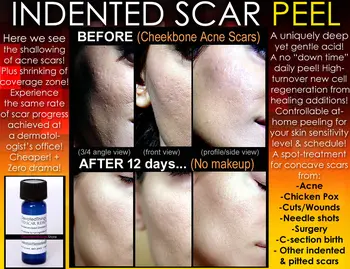 

Indented Acne Scar Removal Peel Chicken Pox Ice pick Rolling Boxcar Scars