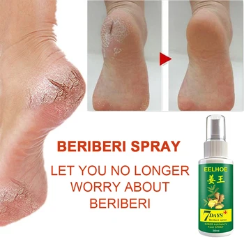 

20/30/50ml Athlete's Foot Odor Sweat Foot Cream Treatment Peeling Feet Erosive Water Sprays B99