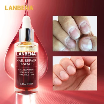 

LANBENA Nail Repair Essence Serum Nail Treatment Remove Fungal Onychomycosis Toe Nourishing Brighten Hands Foot Skin Care 12ml