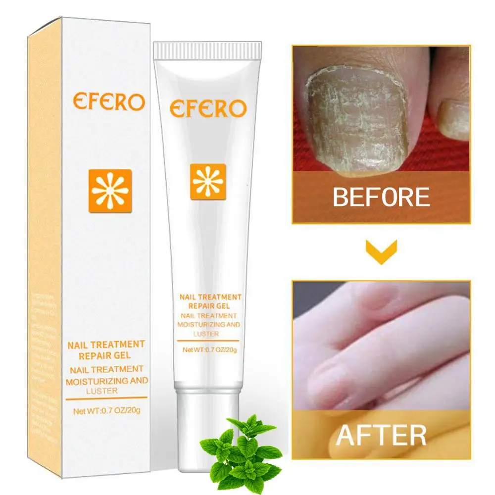 Nail Treatment Repair Cream Chinese Herbal Skin Care Nail Fungus Nails Repair Onychomycosis Paronychia Anti Naturally Treatment Nail Treatment Repair Cream Chinese Herbal Skin Care Nail Fungus Nails Repair Onychomycosis Paronychia Anti Naturally Treatment