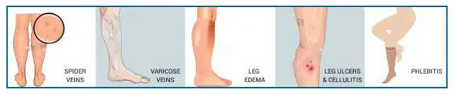 Varcoh 20-30 mmHg Firm Compression