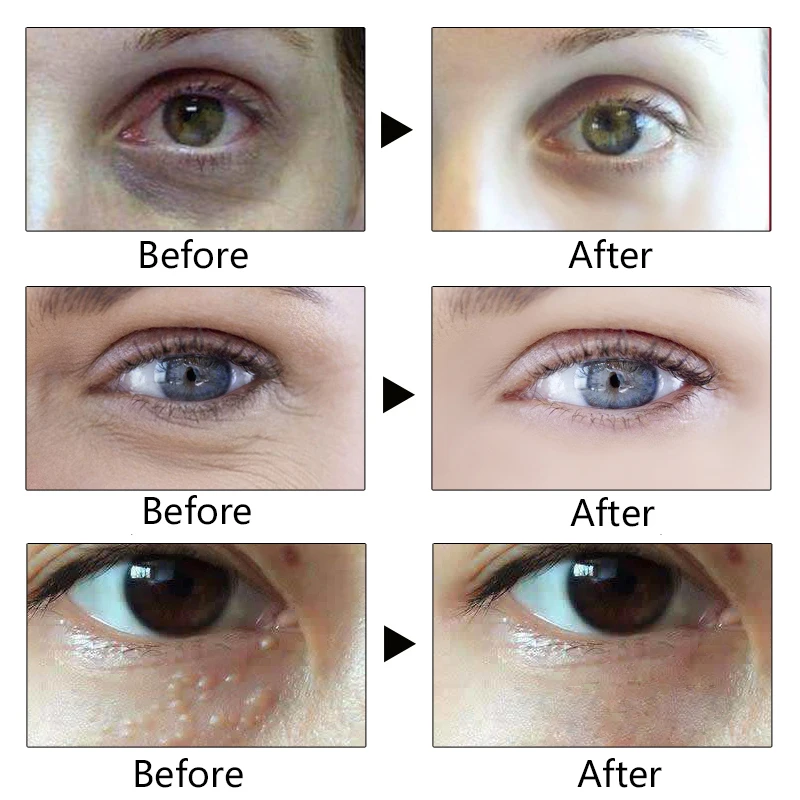 dark under eye cream