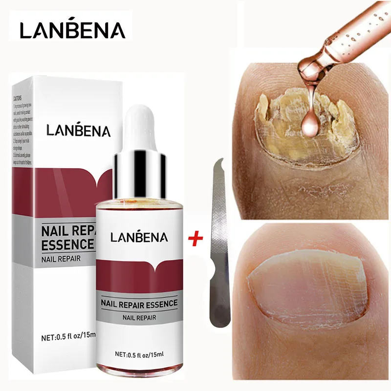 Lanbena Nail Repair Essence Serum Anti Fungal Nail Treatment Remove Onychomycosis Nourishing