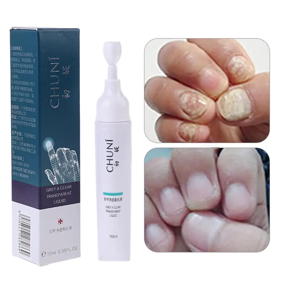 Special Price of  10ml Fungal Removal Toe Nail Infection Treatment Pen Gel Essence Bright Pencil Feet Care Anti Fungu