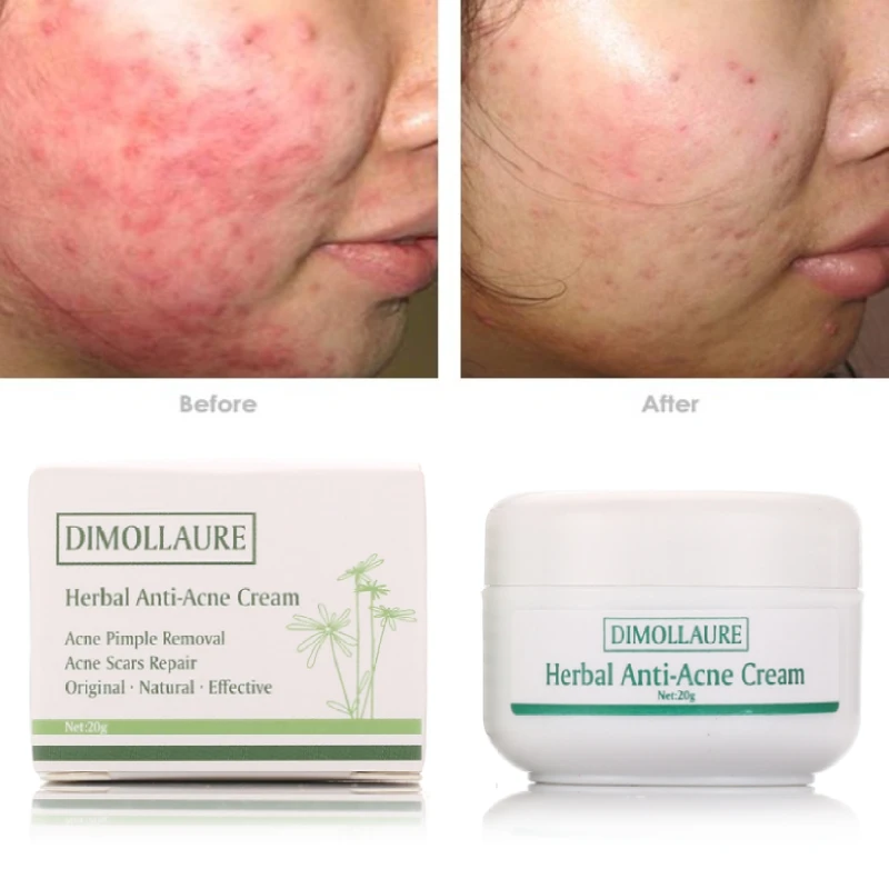 Dimollaure Herbal Ginseng Acne Cream Pimple Spot Acne Scars Blackhead Removal Whitening Beauty Face Care Cream Acne Treament