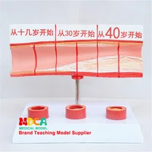 Сосудистый блокирующий концентрацию крови жировой механизм сосудистая патологическая анатомическая модель обучения медицине Mxg006