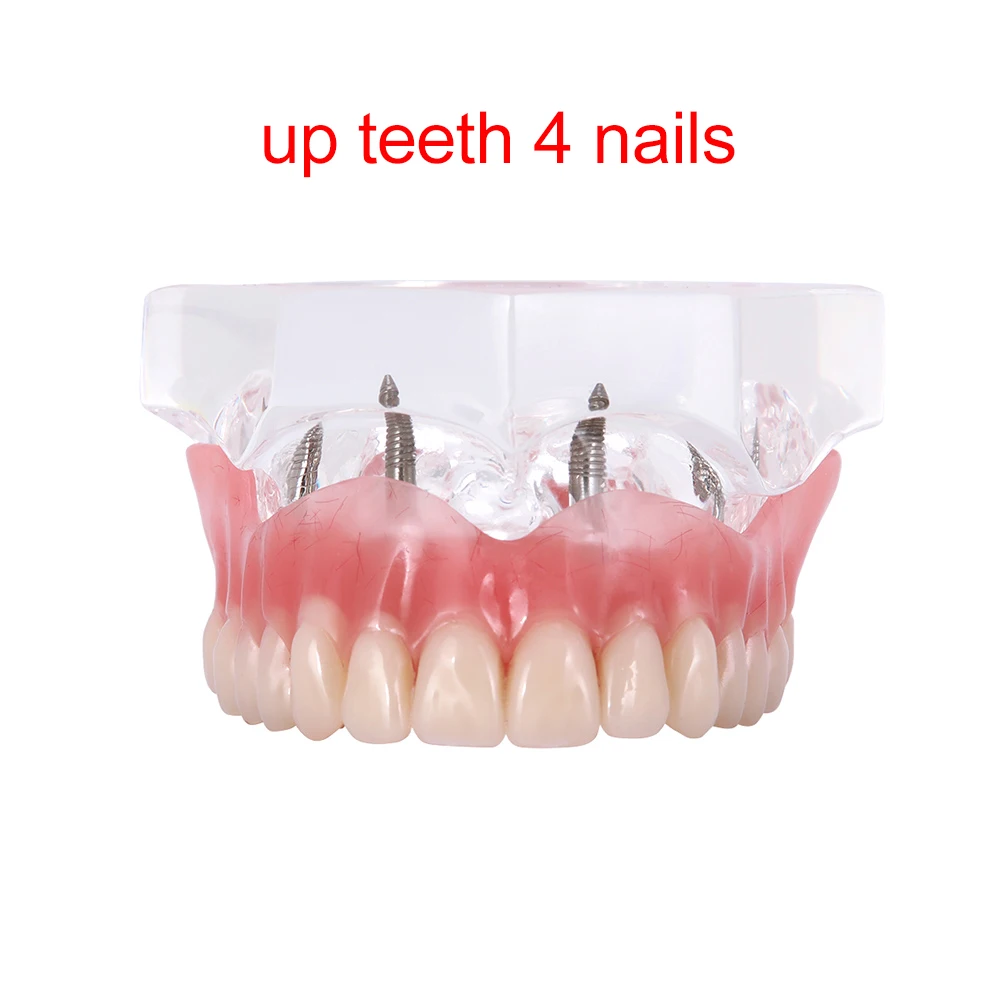 Upper - 4 Implants