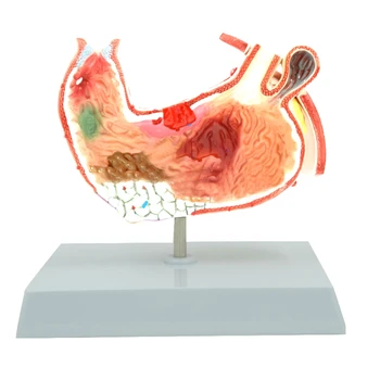 

Human Stomach Anatomy Model Pathological Stomach Model Gastric Pathology