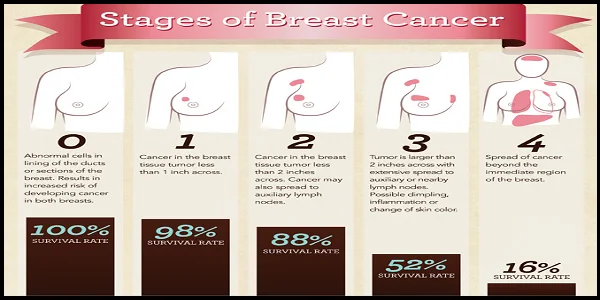 stages-of-breast-cancer-01