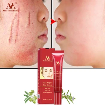 

Acne Scar Stretch Mark Repair Cream Treatment Blackhead Whitening Cream Skin Repair Acne Treatment Face Cream 15ml TSLM1