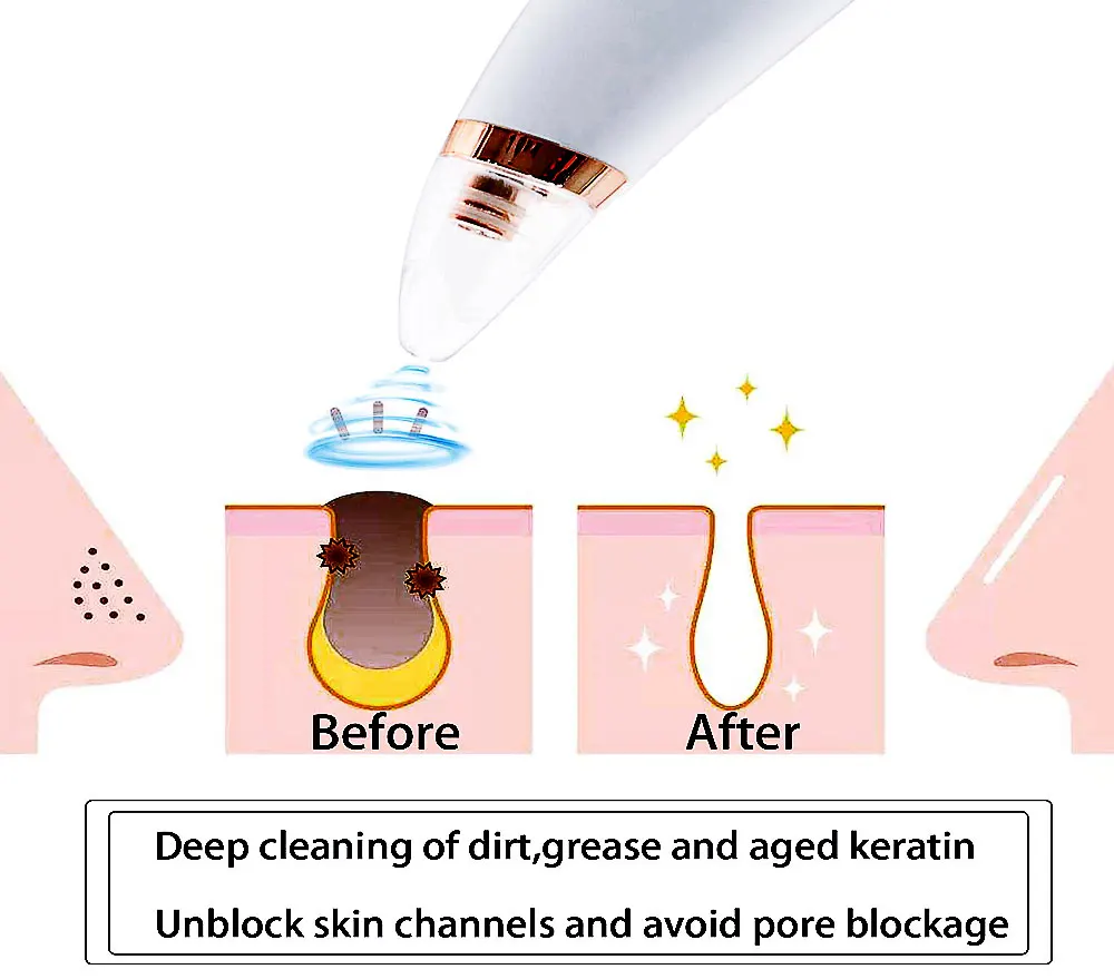 Пылесос для удаления черных точек Licheng для носа и лица, очиститель пор, средство для удаления черных точек и прыщей