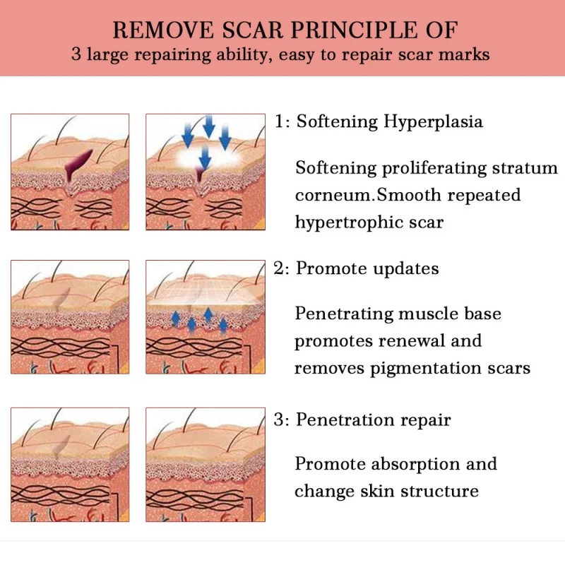 Восстанавливающий крем для удаления шрамов от угревой сыпи, крем от растяжек, хирургический ожог шрамов для пигментации тела, корректор для ухода за кожей