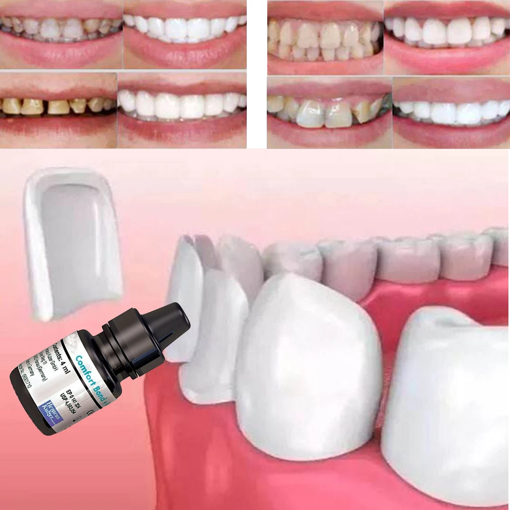 Tooth Veneer Quick Adhesive Dental Comfort Bond Desensitizer Equivalent