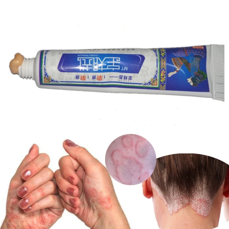 Body Eczema Cream Psoriasis Skin Allergy Dermatitis Itching Repair Chinese Herbal Care |