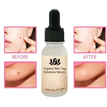 

20ML Organic Tags Solutions Serum Skin Tag Remover Serum Organic Skin Tag Remover Serum Face Wart Tag Mole Freckle Spot Painless