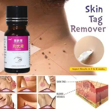 

Skin Tag Remover 12 hours Medical kill Remover Skin Tag Mole I8Q5