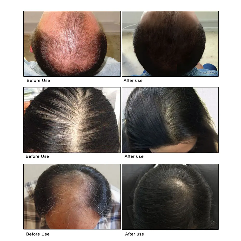 ARTISCARE эссенция для роста волос спрей против выпадения волос Лечение Эфирное масло Предотвращение облысения укрепляющее питание корни волос