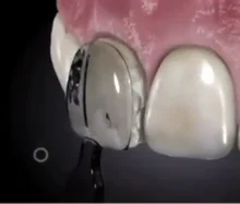 

1 коробка, стоматологическая форма, композитная смола, светоотверждаемые передние зубья, быстрое шпон, шаблон, направляющие, виниры из смолы...