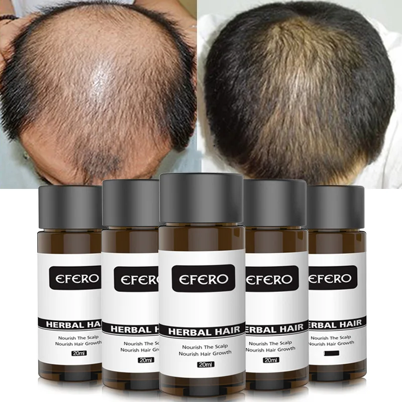 Best Seller Powerful-Serum Hair-Loss Hair-Growth-Prevents Essential-Oil Thicker for To 7WJoRAQeWXO