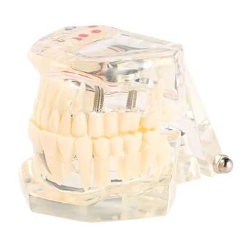 

Transparent Dental Implantation Disease Teeth Model Teaching Teeth Tool Dental Adult Typodont Removable Teeth Model