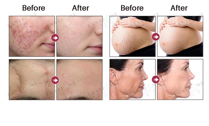 Lanthome Rose fruit oil, repair scars, eliminate wrinkles, increase skin luster