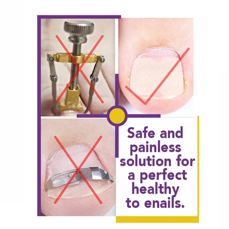 Ingrown Toenail Corrector Sticker Paronychia Treatment Fixer Recover Corrector Pedicure Foot Toe Nail Care Tool Elastic Patch